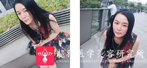 面部提升术
