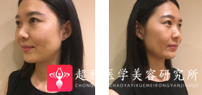 面部提升术