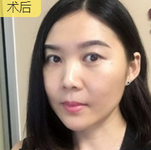 面部提升术