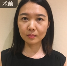 面部提升术