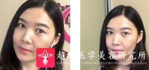 面部提升术
