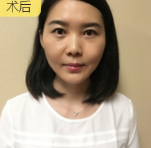 面部提升术