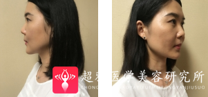 面部提升术