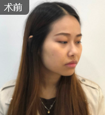 面部提升术