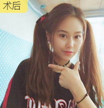 面部提升术