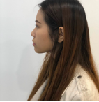 面部提升术