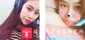 面部提升术
