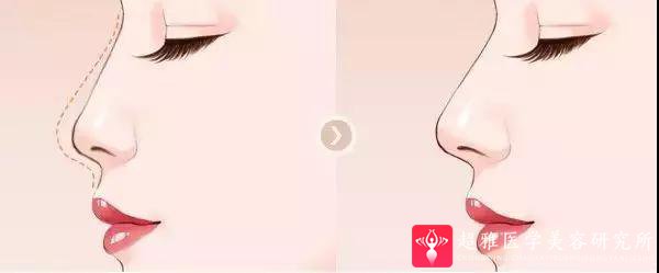 隆鼻手术