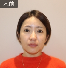 面部提升术