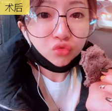 面部提升术