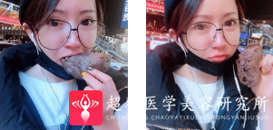 面部提升术