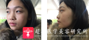 面部提升术