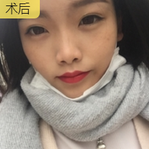 面部提升术