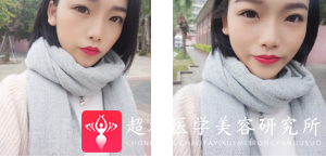 面部提升术