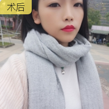 面部提升术