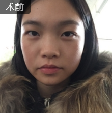面部提升术