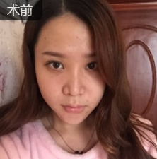 面部提升术