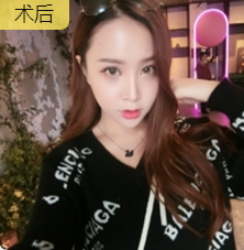 面部提升术