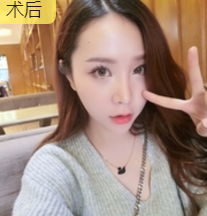面部提升术