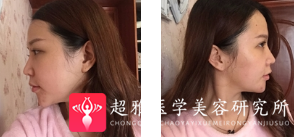 面部提升术