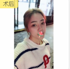 面部提升术