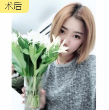 面部提升术