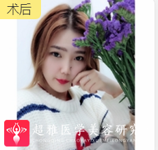 面部提升术