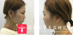 面部提升术