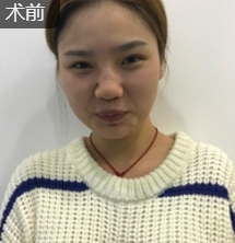 面部提升术
