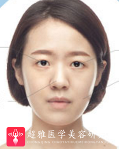 面部提升术