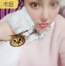 自体脂肪填充术