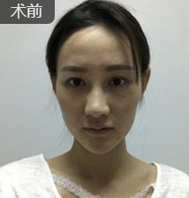 自体脂肪填充术