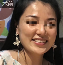 自体脂肪填充术