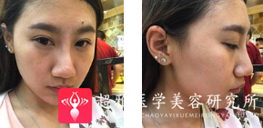 面部提升术