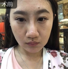 面部提升术