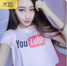 面部提升术