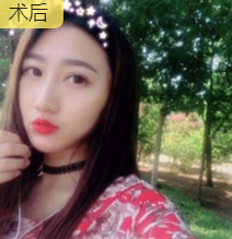 面部提升术