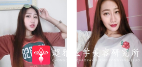 面部提升术