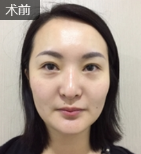 面部提升术