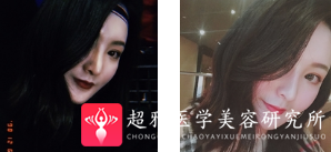 面部提升术