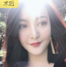 面部提升术