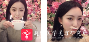 面部提升术