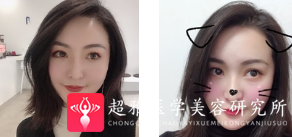 面部提升术
