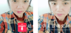 面部提升术