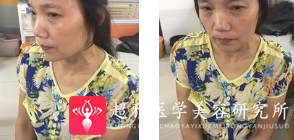 面部提升术