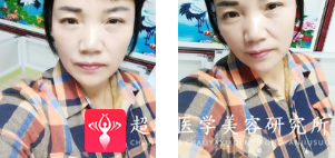 面部提升术