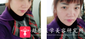 面部提升术