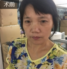 面部提升术