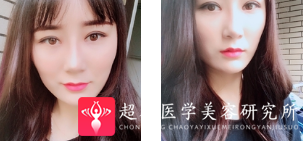 面部提升术