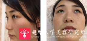 面部提升术